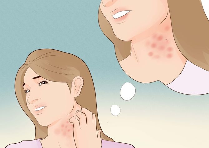 Nước cơm trị bệnh eczema: Tinh bột trong nước cơm sẽ giúp giảm cảm giác rất, mất nước, giúp làm dịu da và giúp vùng da bị eczema nhanh lành.