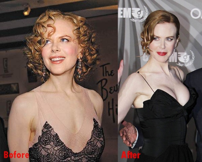 Sao nâng ngực tốn kém ảnh 3 Sao nang nguc ton kem anh 3