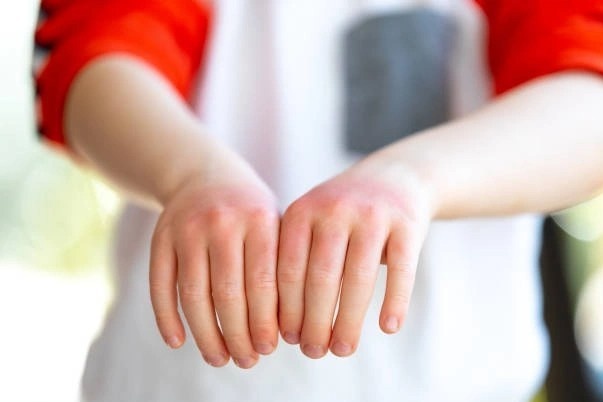 Thuoc dieu tri cham cho benh nhi duoi 6 tuoi hinh anh