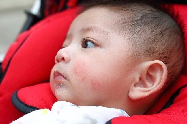 Cach dieu tri phat ban o tre khi moc rang hinh anh