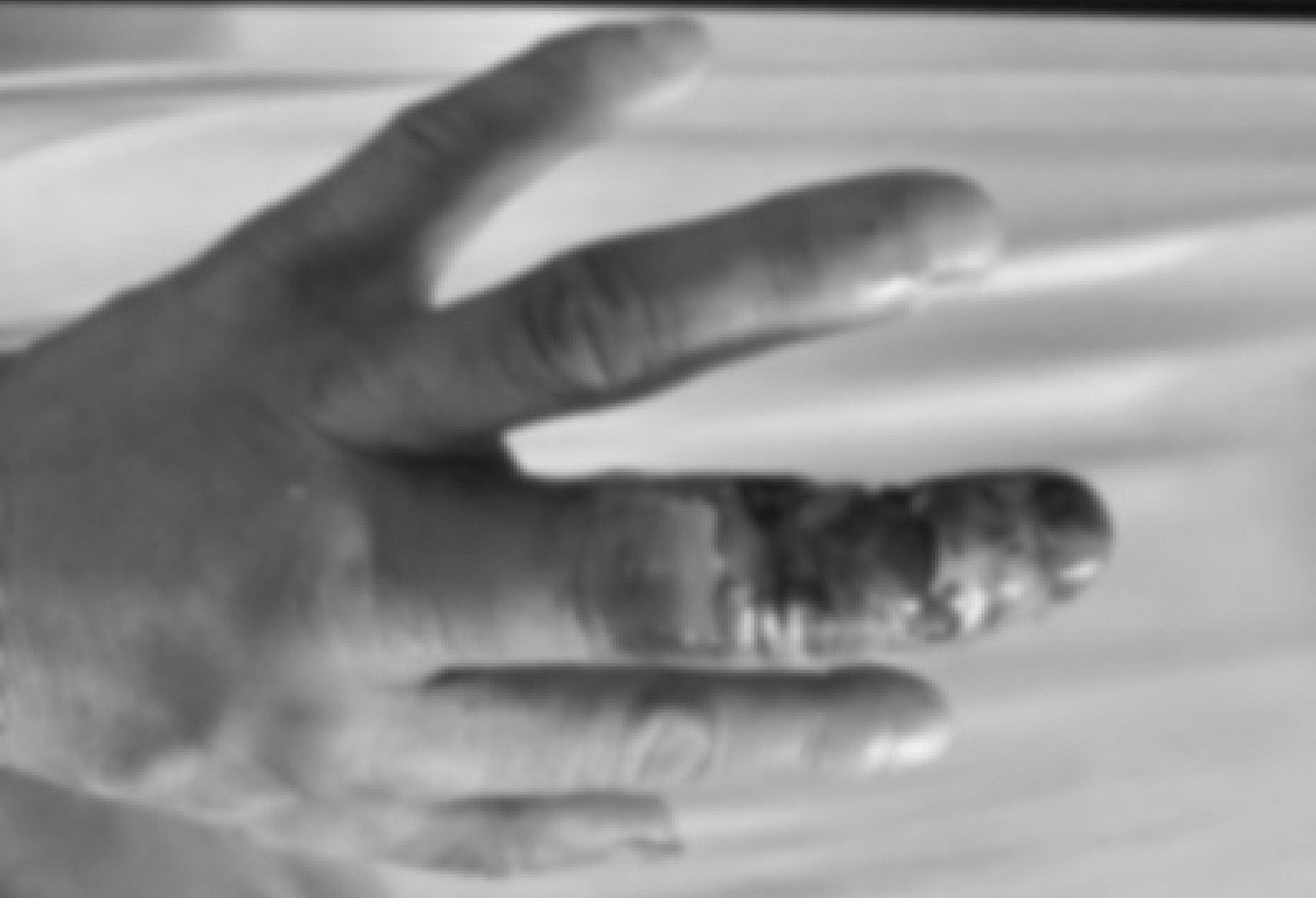 Dap thuoc nam vao vet ran can, nguoi dan ong phai cat bo ngon tay hinh anh