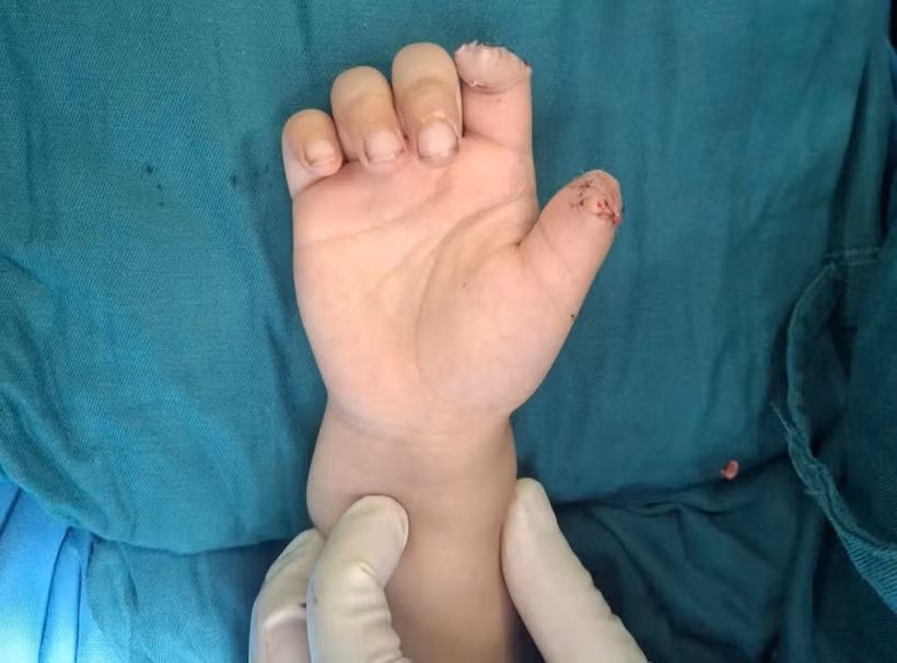 Be trai dut ngon tay anh 1