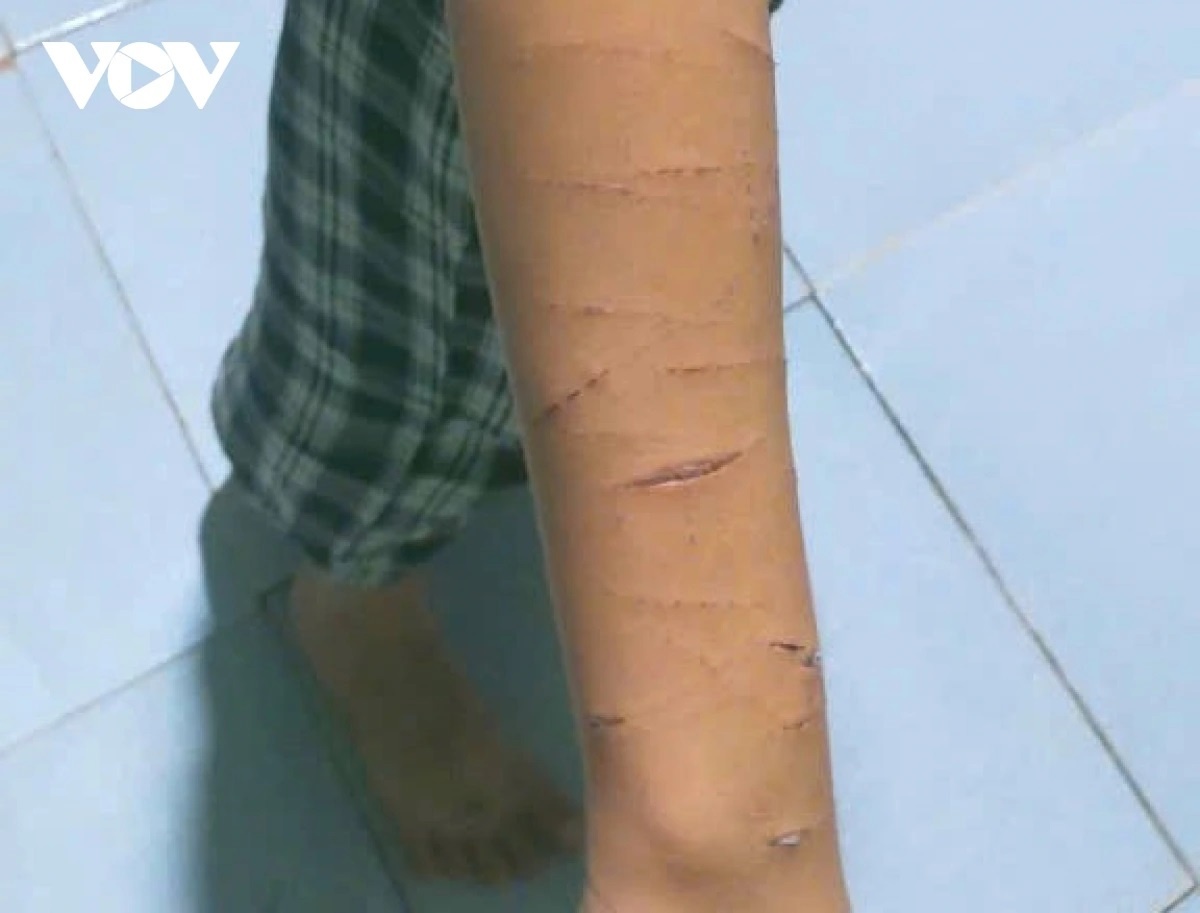 Chi rach tay em anh 1