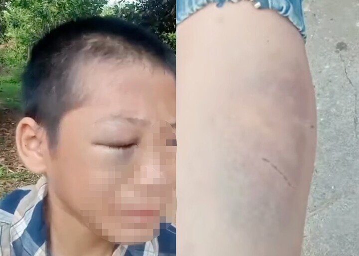 Be trai 11 tuoi,  nghi bi bo,  me ke bao hanh anh 1