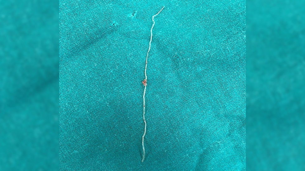 Bi giun song ky sinh trong ma sau lan muoi dot hinh anh