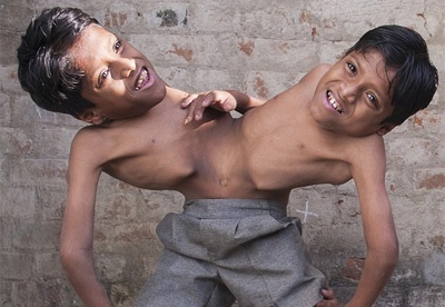 No luc ky dieu cua cap song sinh dinh lien than hinh anh