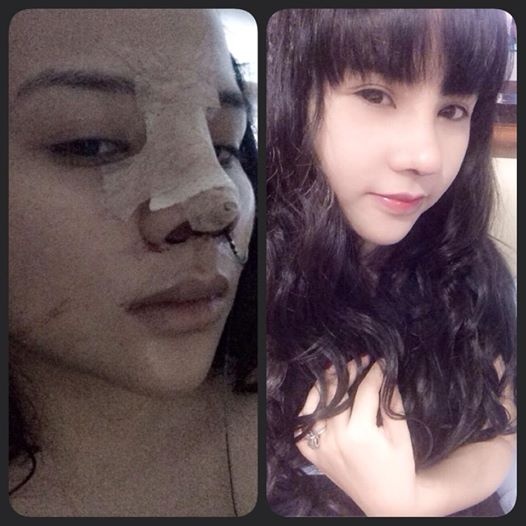 Man lot xac cua thieu nu Ha thanh sau khi phau thuat tham my hinh anh