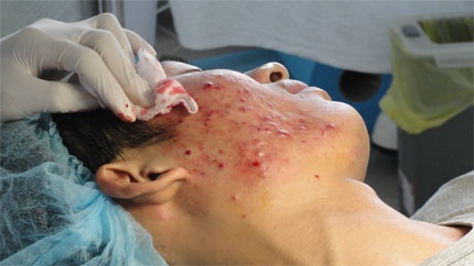 Tri mun  trung ca bang Vitamin B5 va H - dung hay sai? hinh anh