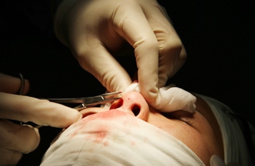 Nhung dieu can phai biet khi nang mui hinh anh