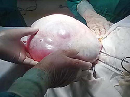 Be gai co khoi u buong trung nang 3 kg hinh anh