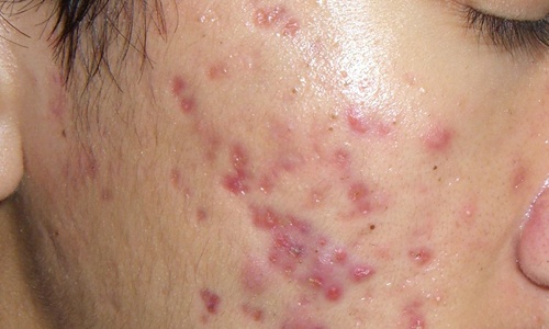 Thuc hu nguy co ung thu tien liet tuyen tu mun hinh anh