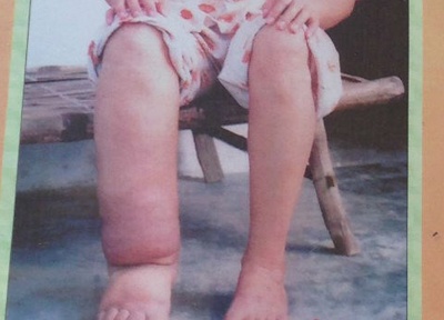 Nhiem giun chi, benh nhan chan to nhu chan voi hinh anh