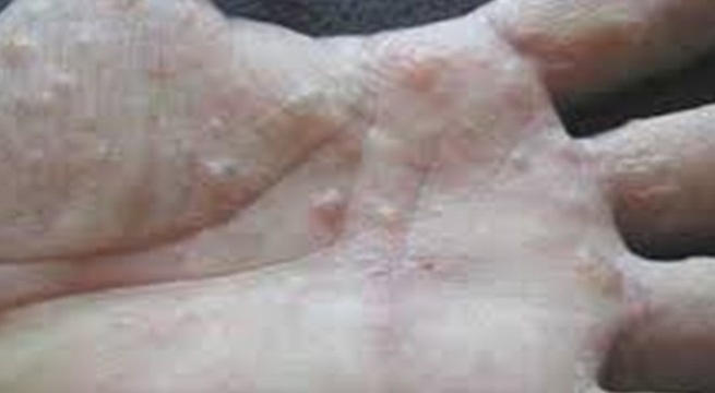 Benh cham to dia va cach tri bang Dong y hinh anh