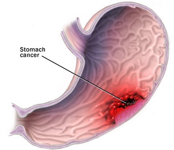 Diem danh 10 benh ung thu cuc nguy hiem hinh anh