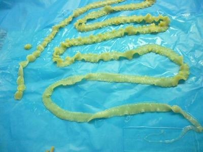 Dot san bo ra tu co the - benh nguy hiem khong ngo toi hinh anh