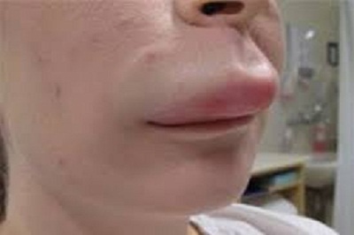 Moi bien dang vi nhiem cung luc ba loai giun hinh anh