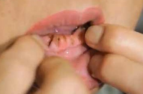 Rung het ham vi danh rang sai cach hinh anh