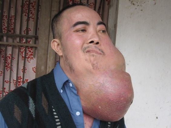 Xot xa nguoi dan ong mang khoi u 10 kg tren mat hinh anh