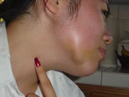 Benh quai bi anh huong den noi giong the nao? hinh anh