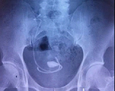 Bo quen 'vat la' trong co the nguoi benh suot 10 nam hinh anh