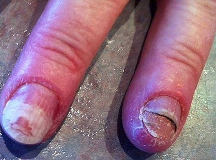 Hong mong vinh vien vi son sua ngoai tiem hinh anh