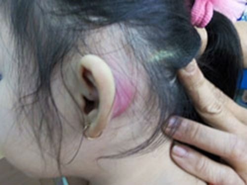 Lo nho xiu nhu dau kim o vanh tai tre la benh gi? hinh anh