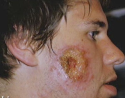 Lom ma vi nhiem ky sinh trung an da hinh anh