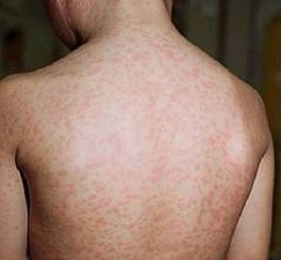 Mon an giup benh soi nhanh khoi hinh anh