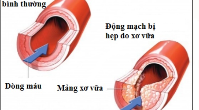 Se co dong mach nhan tao hinh anh