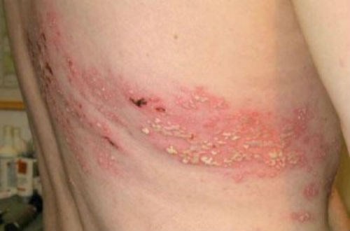 Benh zona moc cho nao nguy hiem nhat? hinh anh