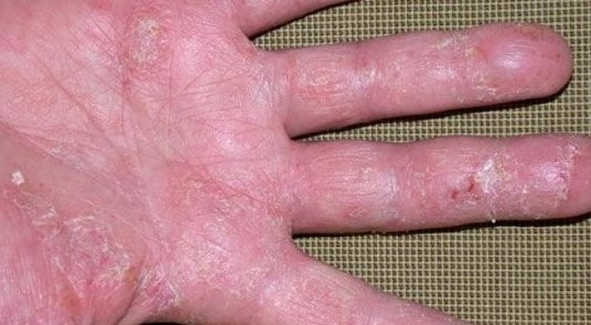 Cach dieu tri benh to dia hinh anh