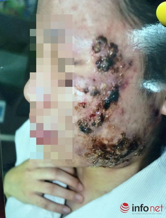 Hình ảnh mụn chi chít vì lạm dụng mỹ phẩm.