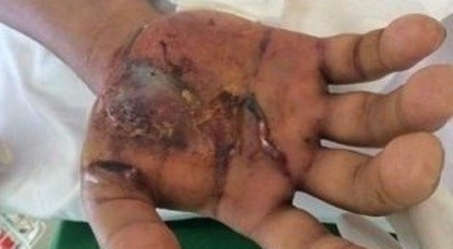 Xu tri dung khi bi ran can hinh anh