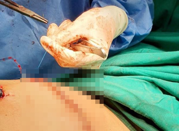 Hai thanh nien bi dam xuyen tim duoc cuu song trong dem hinh anh