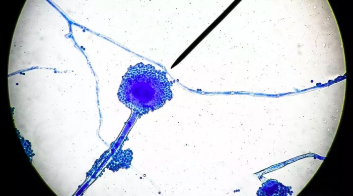 Benh 'Nam den' chet nguoi tan cong nan nhan Covid-19 tai An Do hinh anh