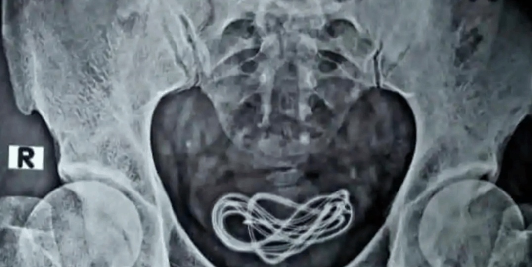 Phat hien cap sac di dong ben trong bang quang mot nguoi dan ong hinh anh