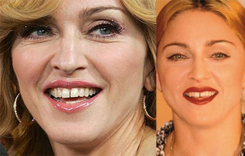 Madonna   Hàm răng với một kẽ hở khá rộng đã trở thành một trong những dấu ấn đặc trưng của nữ hoàng nhạc Pop Madonna. Mặc dù nó khiến nụ cười của Madonna không hoàn hảo nhưng cô không bao giờ tìm cách sửa chữa bởi kẽ hở răng đã khiến chủ nhân của nó trở nên đặc biệt. 