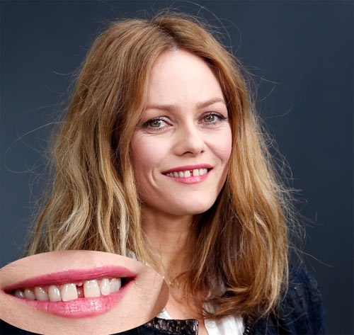 Vanessa Paradis   Một số ngôi sao cũng không chỉnh nha vì nó đem lại cho họ sự quyến rũ và may mắn. Kẽ hở răng rất rộng đã khiến người đẹp Pháp Vanessa Paradis trở nên nổi tiếng. Cũng chính kẽ hở răng ấy đã thu hút và níu giữ được 