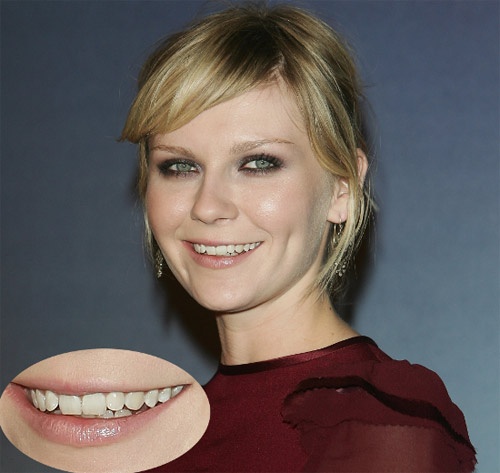 Kirsten Dunst    Kristen Dunst có một nhược điểm lớn nhất, đó là hàm răng nhỏ, không đều. Tuy nhiên, cô cho biết mình sẽ không bao giờ sửa răng bởi: 