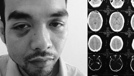 Nạn nhân bị một nhóm côn đồ dùng gậy bi–a vụt khiến khuôn mặt bị biến dạng