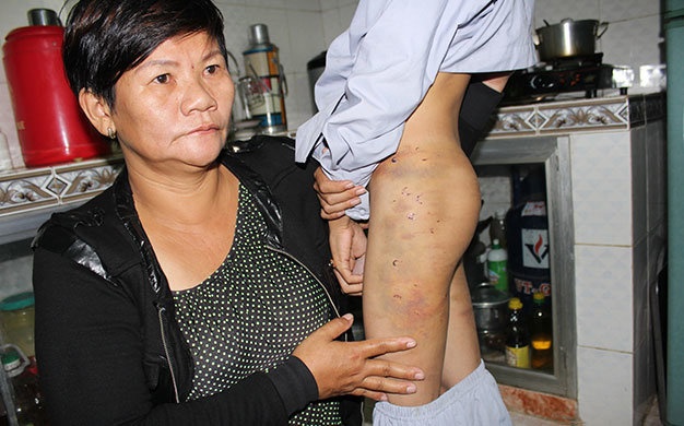 Bà Lê Thị Vin đau lòng trước những lằn roi dày đặc, đang lở loét trên mông và hai chân của con.