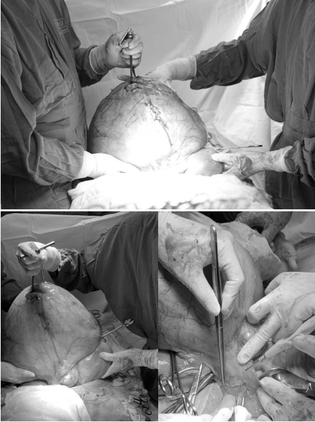 Nguoi phu nu mu mang khoi u xo tu cung khong lo anh 1