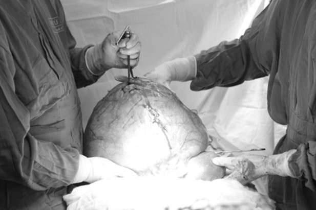 Nguoi phu nu mu mang khoi u xo tu cung khong lo nhu bau 9 thang hinh anh