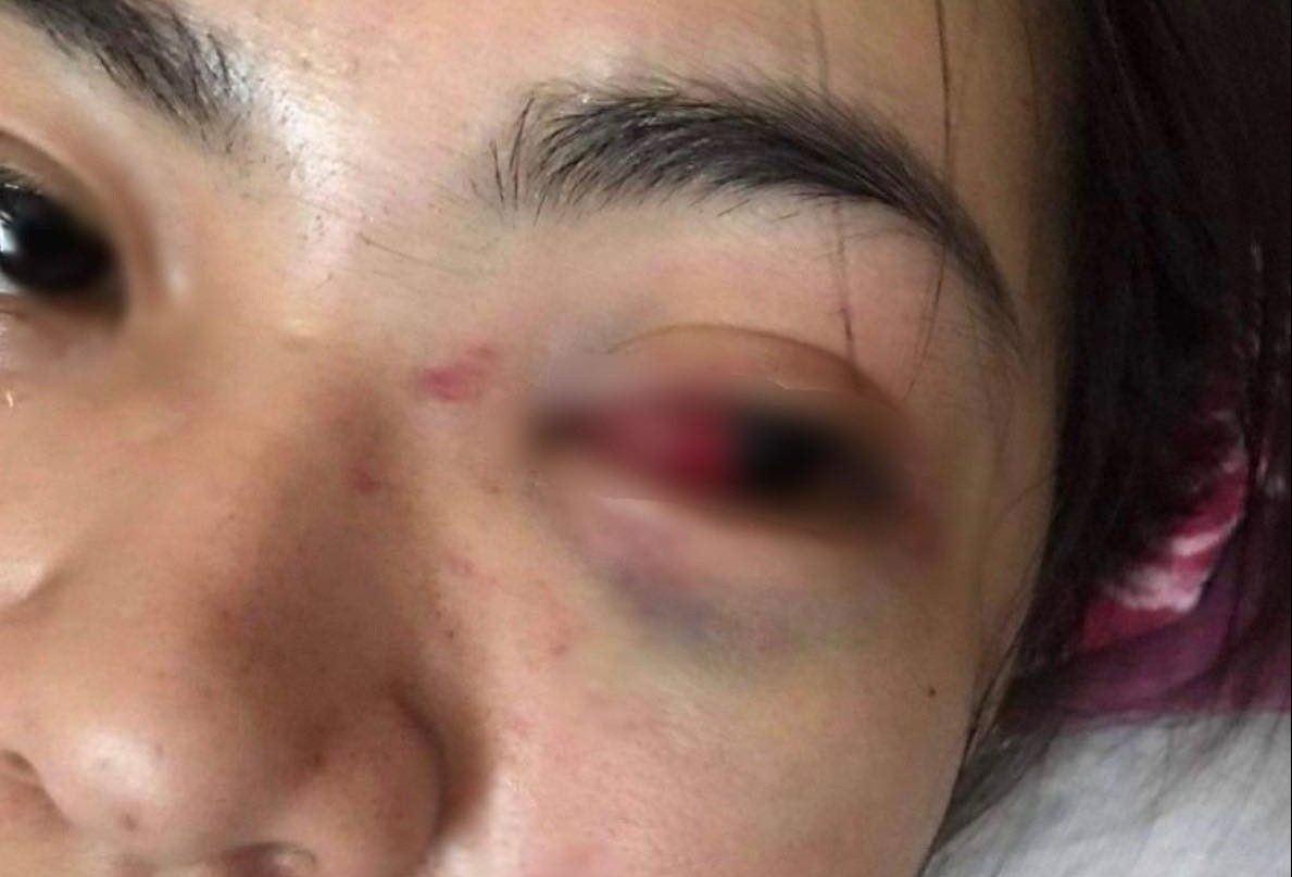 Nu sinh lop 11 bi nhom ban danh tu mau mat hinh anh