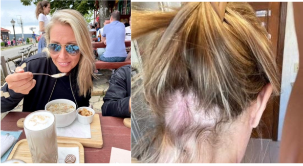 gây chứng hói đầu  ảnh 1 gay chung hoi dau anh 1