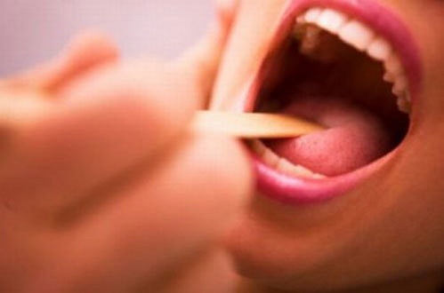 sỏi amidan,  đốm trắng ảnh 2 soi amidan,  dom trang anh 2