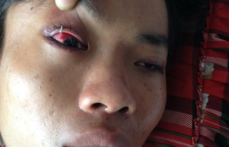 Anh Thành bị đánh bầm mắt, dập lá lách đang được điều trị tại bệnh viện