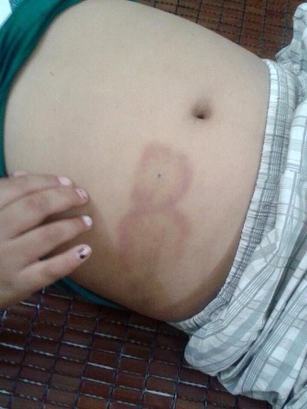 Những vết thương trên người cháu Khánh.