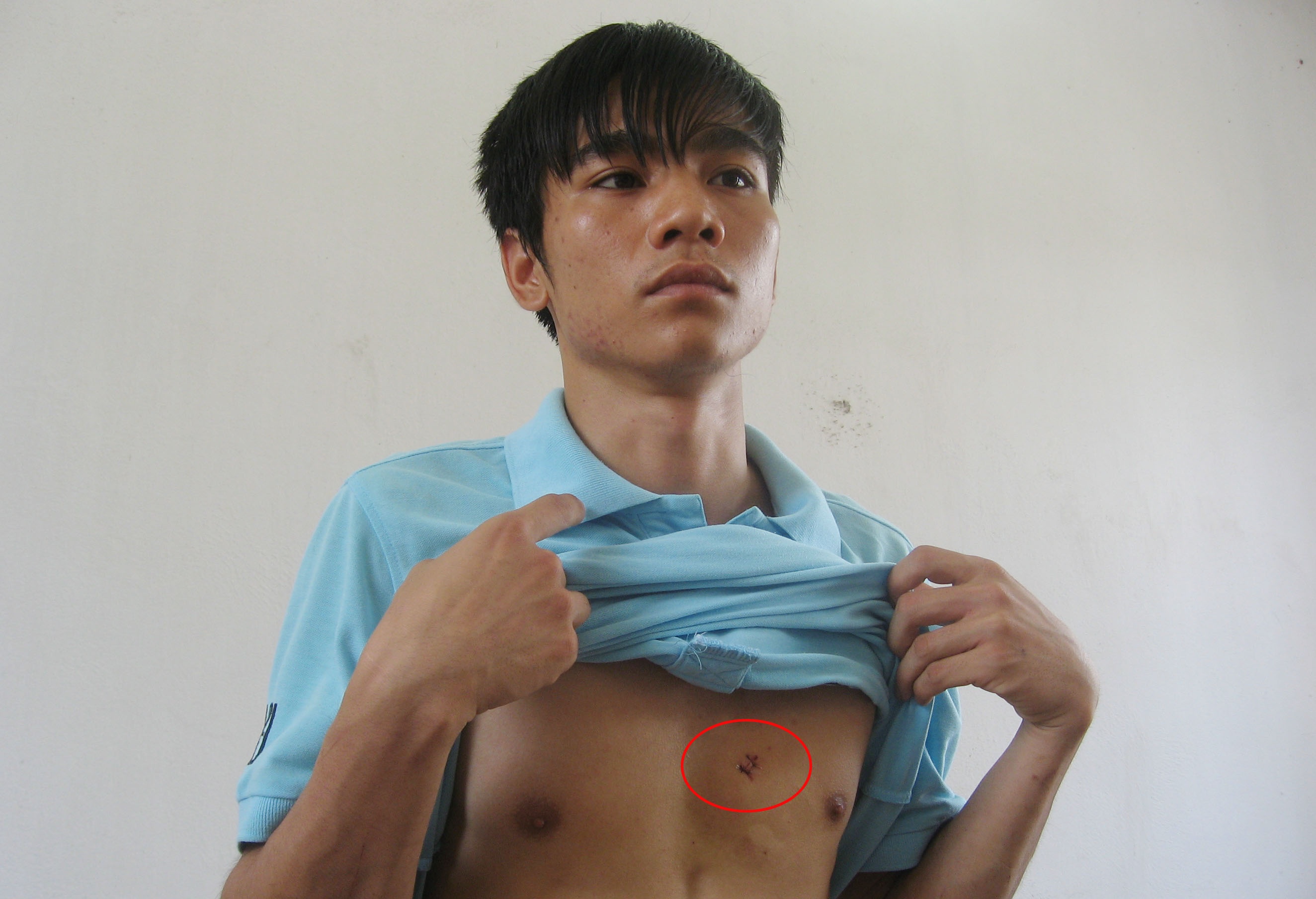 Thế Anh vén áo để lộ vết dao tự đâm vào ngực. Ảnh: Việt Đức.