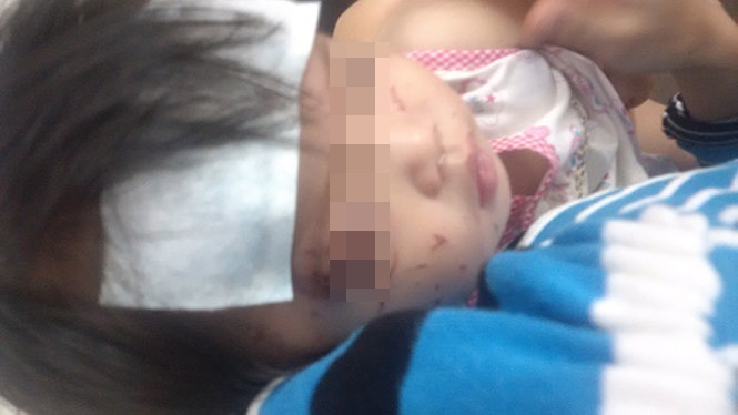 Cháu Bùi Thị Như Ý bị bạn cùng lớp cào cấu gây nhiều vết rách trên vùng mặt.